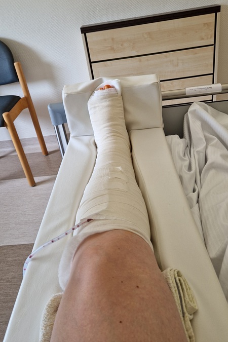 Ein Krankenhaus-Bett mit einem verbundenen, operierten Bein.