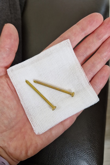 Zwei Stellschrauben, so groß wie ein Handteller, die im Bein waren